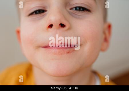 Nahaufnahme der verwitterten Lippen eines Jungen und der Haut um seine Lippen. Hochwertige Fotos Stockfoto