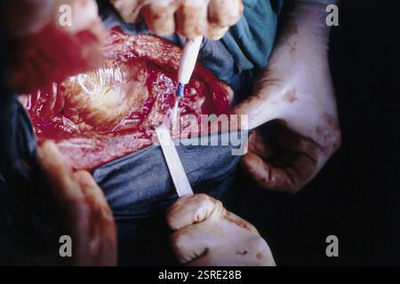 Nahaufnahme von Operationen am offenen Herzen, Indien, Asien Stockfoto