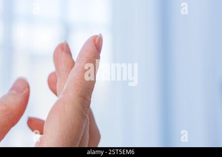 Nahaufnahme einer Frau trockene Hände mit abblätternder Haut im Winter, Hautpflege- und Hydratationskonzept. Stockfoto