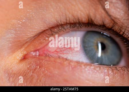 Blutgefäße sind im gereizten Auge deutlich sichtbar, was die Beschwerden und Entzündungen hervorhebt, die mit Konjunktivitis, auch bekannt als rosa Auge, verbunden sind Stockfoto