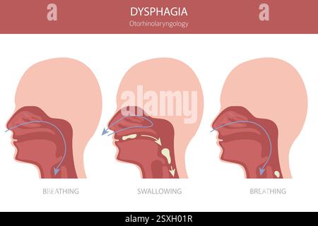 Orale Dysphagie-Erkrankungen. Hals-Nasen-Ohrenheilkunde. Schluckbeschwerden. Medizinische Infografik. Vektorabbildung Stock Vektor