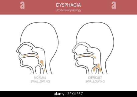Orale Dysphagie-Erkrankungen. Hals-Nasen-Ohrenheilkunde. Schluckbeschwerden. Medizinische Infografik. Vektorabbildung Stock Vektor