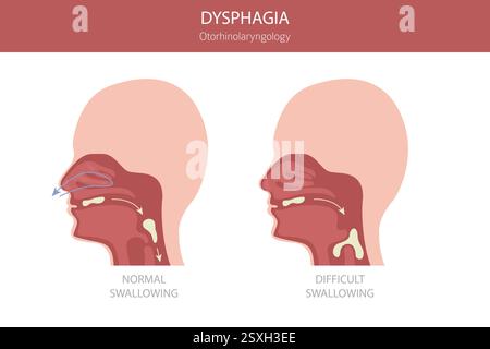 Orale Dysphagie-Erkrankungen. Hals-Nasen-Ohrenheilkunde. Schluckbeschwerden. Medizinische Infografik. Vektorabbildung Stock Vektor