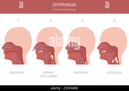 Orale Dysphagie-Erkrankungen. Hals-Nasen-Ohrenheilkunde. Schluckbeschwerden. Medizinische Infografik. Vektorabbildung Stock Vektor