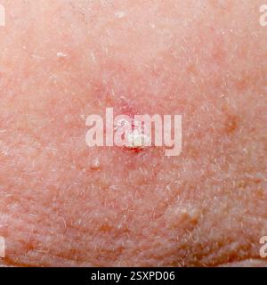 Aktinische Keratose oder Basalzellkarzinom auf der Kopfhaut eines Erwachsenen Stockfoto
