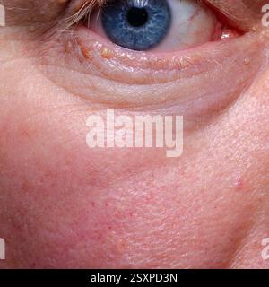 Papillom am menschlichen Auge Nahaufnahme Stockfoto