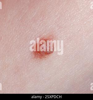 Naevus oder Maulwurf auf der Haut des menschlichen Körpers Nahaufnahme. Stockfoto