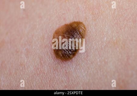 Muttermal oder Papillom oder Keratopapillom auf menschlicher Hautnaht Stockfoto