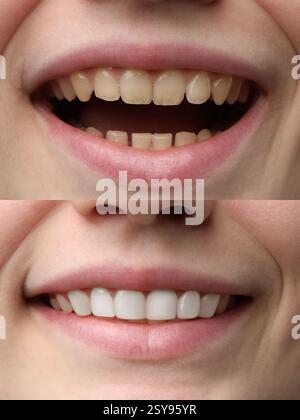 Lächelnde Frau vor und nach dem Eingriff Zahnfurnierplatzierung, Nahaufnahme. Ästhetische Verbesserung der Zähne, Collage Stockfoto