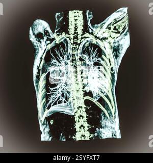 Farbige 3D-Thorax-Computertomographie (CT) der Lunge eines Patienten mit Lungenkrebs, die eine feste Masse (Mitte links) in der rechten Lunge zeigt. Stockfoto
