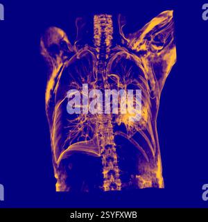 Farbige 3D-Thorax-Computertomographie (CT) der Lunge eines Patienten mit Lungenkrebs, die eine feste Masse (Mitte links) in der rechten Lunge zeigt. Stockfoto