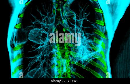 Farbige 3D-Thorax-Computertomographie (CT) der Lunge eines Patienten mit Lungenkrebs, die eine feste Masse (Mitte links) in der rechten Lunge zeigt. Stockfoto