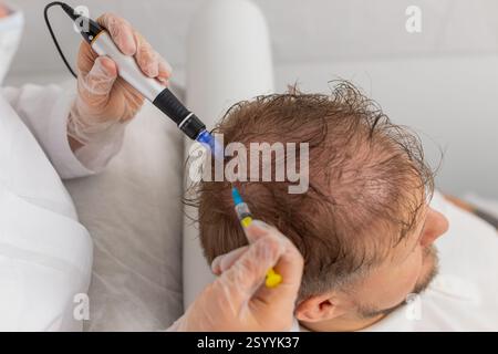 Alopezie. Mann Haarausfall verbessern Wachstumsbehandlung Regeneration, Dermapen Mikroneedling Vitamin Exosomen Spritzen Injektionen. Trichologe Kosmetologe Arzt KopfKopfKopfhautverfahren fraktionelle Mesotherapie Stockfoto
