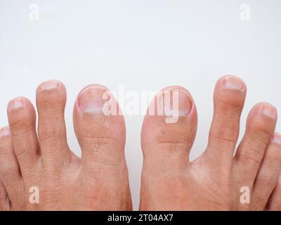 Zehen mit Nagelkrankheit isoliert auf weißem Hintergrund Stockfoto