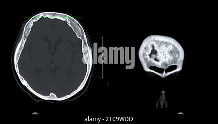 CT-Scan der sagittalen Hirnansicht zur Diagnose von Hirntumor, Schlaganfallerkrankungen und Gefäßerkrankungen. Stockfoto