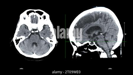 CT-Scan der sagittalen Hirnansicht zur Diagnose von Hirntumor, Schlaganfallerkrankungen und Gefäßerkrankungen. Stockfoto