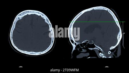 CT-Scan der sagittalen Hirnansicht zur Diagnose von Hirntumor, Schlaganfallerkrankungen und Gefäßerkrankungen. Stockfoto