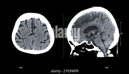 CT-Scan der sagittalen Hirnansicht zur Diagnose von Hirntumor, Schlaganfallerkrankungen und Gefäßerkrankungen. Stockfoto