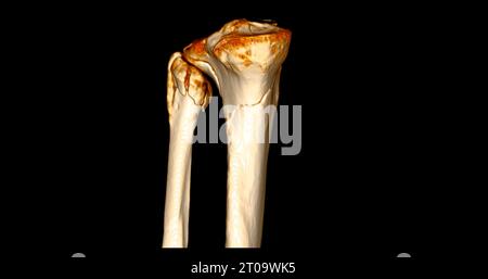 CT-Scan des Kniegelenkes mit 3D-Rendering von Tibia- und Fibulaknochen-Frakturen. Stockfoto