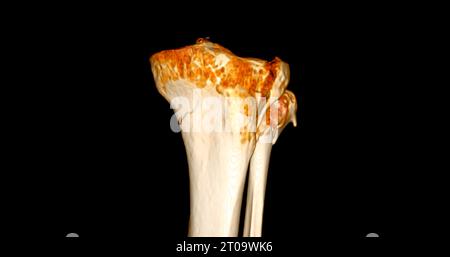 CT-Scan des Kniegelenkes mit 3D-Rendering von Tibia- und Fibulaknochen-Frakturen. Stockfoto