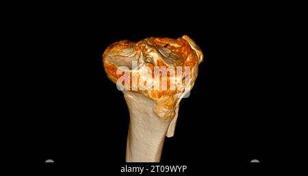 CT-Scan des Kniegelenkes mit 3D-Rendering von Tibia- und Fibulaknochen-Frakturen. Stockfoto