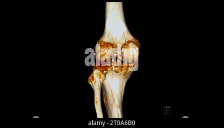 CT-Scan des Kniegelenkes mit 3D-Rendering von Tibia- und Fibulaknochen-Frakturen. Stockfoto