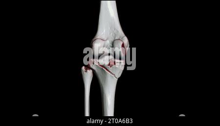 CT-Scan des Kniegelenkes mit 3D-Rendering von Tibia- und Fibulaknochen-Frakturen. Stockfoto