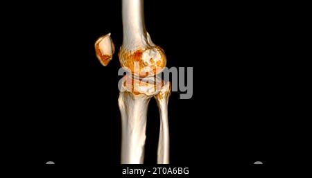 CT-Scan des Kniegelenkes mit 3D-Rendering von Tibia- und Fibulaknochen-Frakturen. Stockfoto