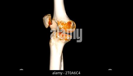CT-Scan des Kniegelenkes mit 3D-Rendering von Tibia- und Fibulaknochen-Frakturen. Stockfoto