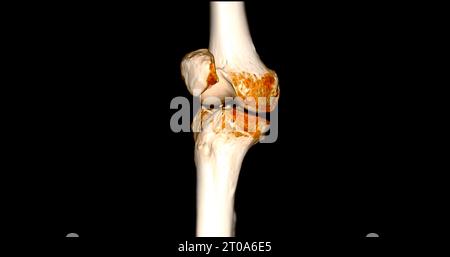 CT-Scan des Kniegelenkes mit 3D-Rendering von Tibia- und Fibulaknochen-Frakturen. Stockfoto