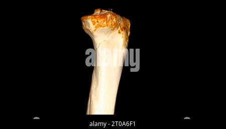 CT-Scan des Kniegelenkes mit 3D-Rendering von Tibia- und Fibulaknochen-Frakturen. Stockfoto