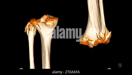CT-Scan des Kniegelenkes mit 3D-Rendering von Tibia- und Fibulaknochen-Frakturen. Stockfoto