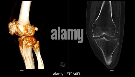 CT-Scan des Kniegelenkes mit 3D-Rendering von Tibia- und Fibulaknochen-Frakturen. Stockfoto