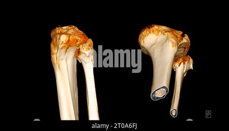 CT-Scan des Kniegelenkes mit 3D-Rendering von Tibia- und Fibulaknochen-Frakturen. Stockfoto