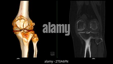 CT-Scan des Kniegelenkes mit 3D-Rendering von Tibia- und Fibulaknochen-Frakturen. Stockfoto