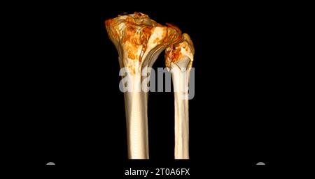 CT-Scan des Kniegelenkes mit 3D-Rendering von Tibia- und Fibulaknochen-Frakturen. Stockfoto
