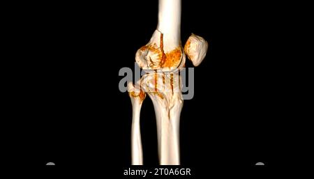 CT-Scan des Kniegelenkes mit 3D-Rendering von Tibia- und Fibulaknochen-Frakturen. Stockfoto