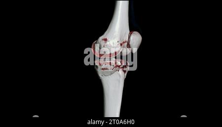 CT-Scan des Kniegelenkes mit 3D-Rendering von Tibia- und Fibulaknochen-Frakturen. Stockfoto