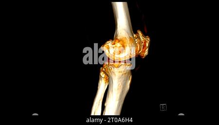 CT-Scan des Kniegelenkes mit 3D-Rendering von Tibia- und Fibulaknochen-Frakturen. Stockfoto