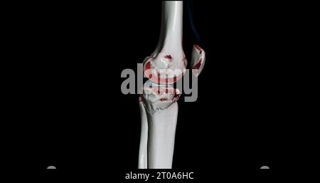 CT-Scan des Kniegelenkes mit 3D-Rendering von Tibia- und Fibulaknochen-Frakturen. Stockfoto