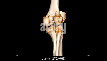 CT-Scan des Kniegelenkes mit 3D-Rendering von Tibia- und Fibulaknochen-Frakturen. Stockfoto