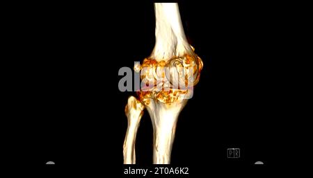 CT-Scan des Kniegelenkes mit 3D-Rendering von Tibia- und Fibulaknochen-Frakturen. Stockfoto