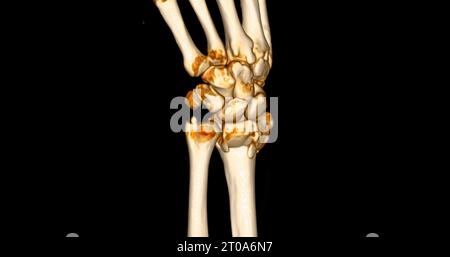 CT-Scan des 3D-Renderings des Handgelenkes zur Diagnose von Handgelenkschmerzen. Stockfoto