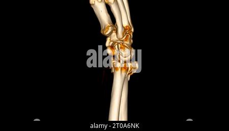 CT-Scan des 3D-Renderings des Handgelenkes zur Diagnose von Handgelenkschmerzen. Stockfoto