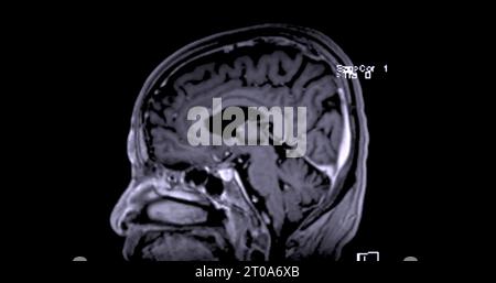 MRT-Scan des Gehirns für Detect Gehirnerkrankungen Sush wie Schlaganfall Krankheit, Hirntumoren und Infektionen. Stockfoto