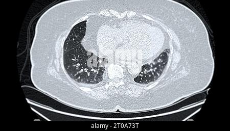 CT-Scan der axialen Thoraxansicht bei diagnostischer Lungenembolie (PE), Lungenkrebs und covid-19. Stockfoto