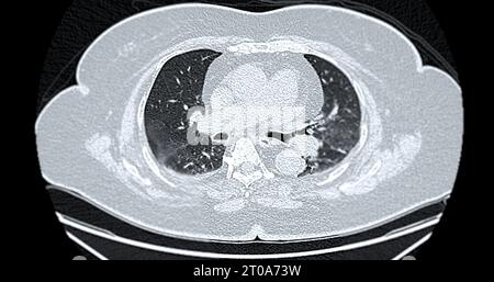 CT-Scan der axialen Thoraxansicht bei diagnostischer Lungenembolie (PE), Lungenkrebs und covid-19. Stockfoto