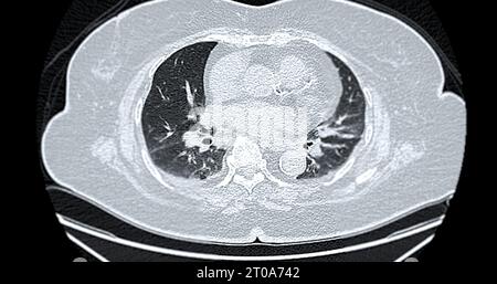 CT-Scan der axialen Thoraxansicht bei diagnostischer Lungenembolie (PE), Lungenkrebs und covid-19. Stockfoto