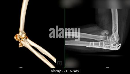 CT-Darstellung der 3D-Darstellung des Ellenbogengelenkes. Stockfoto