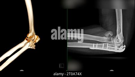 CT-Darstellung der 3D-Darstellung des Ellenbogengelenkes. Stockfoto